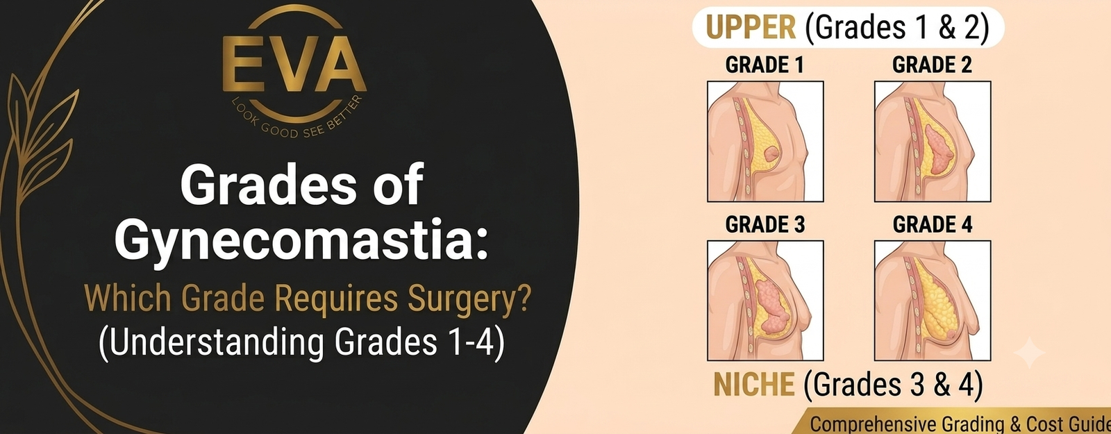 Grade 1, 2, 3 and 4 Gynecomastia: Which Grade Requires Surgery?